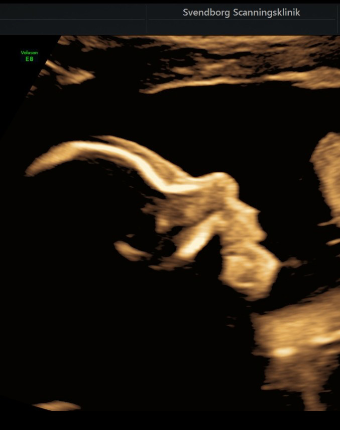 2d scanning gravid