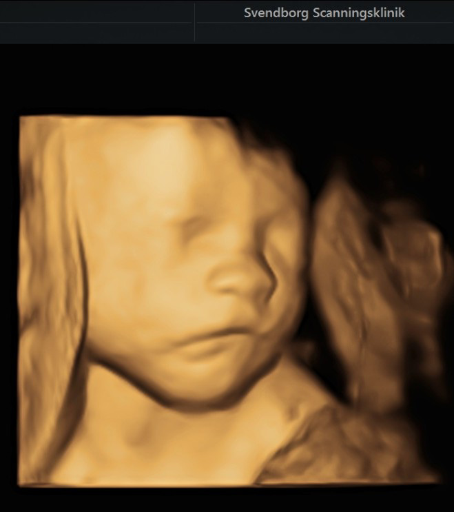 3D scanning af gravide